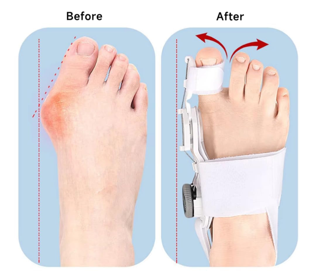 OrthoFlex Correcteur d'Hallux Valgus™